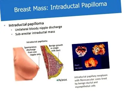 ascites