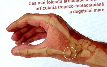 osteoarthritisje fordul