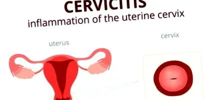 cervicitis méhnyak-gyulladás