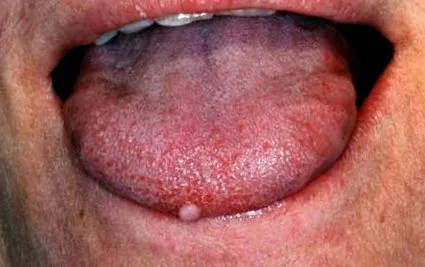 papilloma hogyan