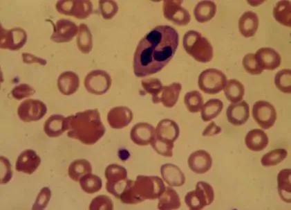 hemoglobin