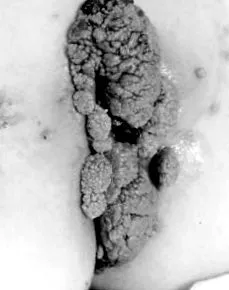 condylomata
