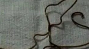 ascariasis kezelésére