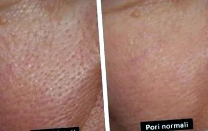 pórusokra