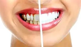 gingivitis