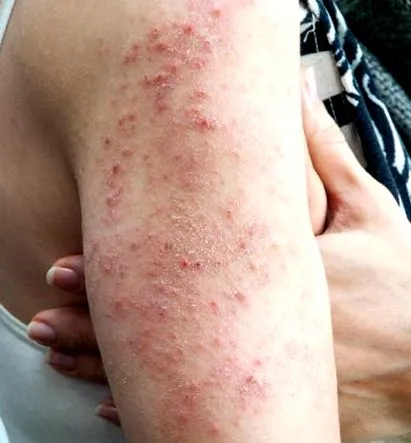 herpetiform dermatitis