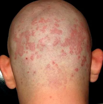 seborrheás dermatitis