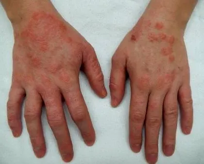 herpetiform dermatitis