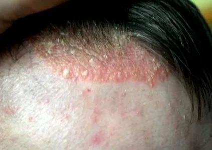 seborrheás dermatitis