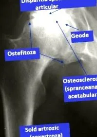 csípőízület diéta