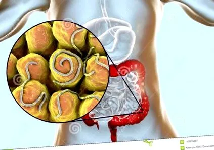enterobiasis