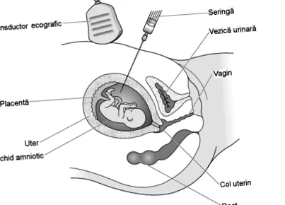 amniocentesis