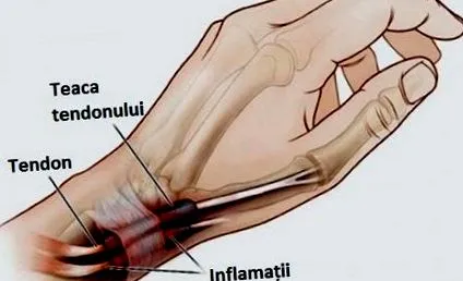 egészségügyi gyulladása
