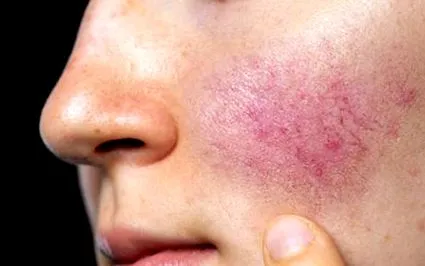 rosacea
