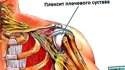 ízületi osteoarthritisét