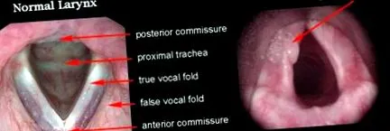 papillomatosis vénáinak