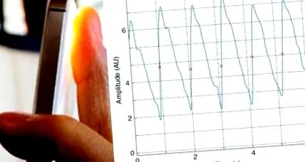 pitvarfibrilláció