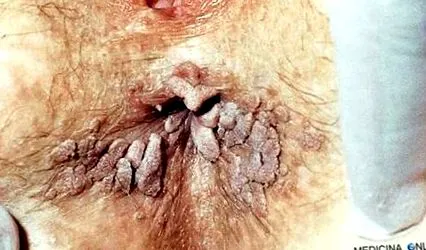 paraziták papilloma vírus