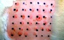 hiposzenzibilizáció