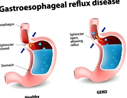 reflux