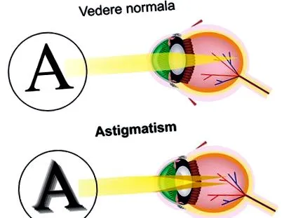 hyperopia