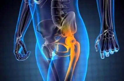 osteoarthritis