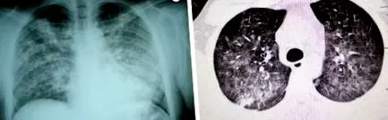 pulmonalis