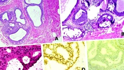 papilloma