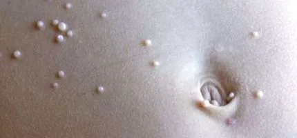 contagiosum bőrfertőzés