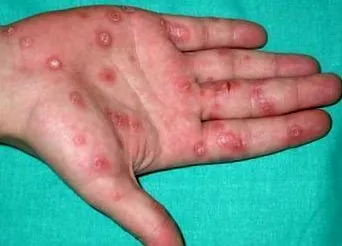 vírusos hepatitis
