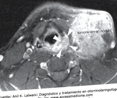 papilloma papilloma