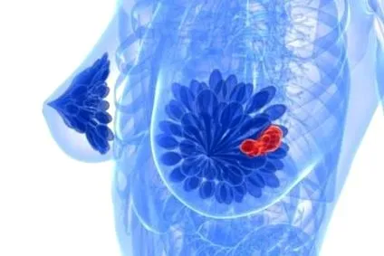 papilloma csomó