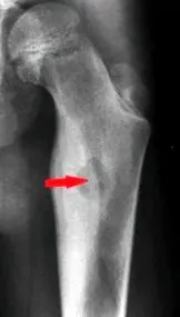 osteoblastoma