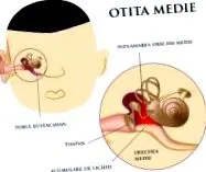 akut otitis akut otitis