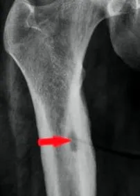 osteoma osteoblastoma