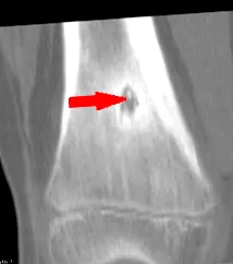 osteoid osteoma