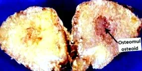 osteoma osteoblastoma