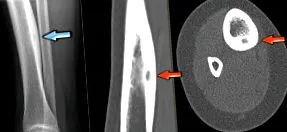 osteoma