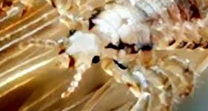 eosinophilia