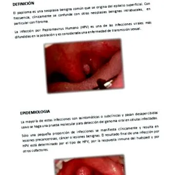 papilloma