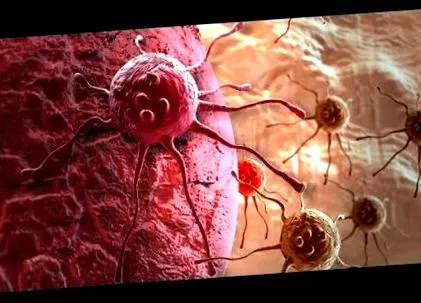 papilloma