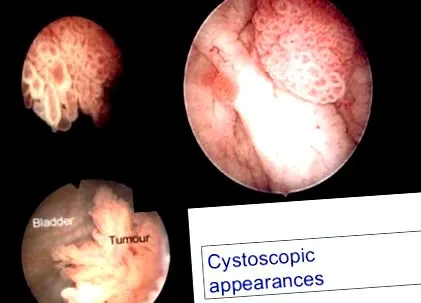papilloma pleomorf adenoma