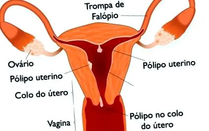 polyp