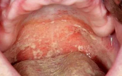 csap epithelium