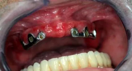 epithelialis papilloma