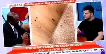 папилома папилома