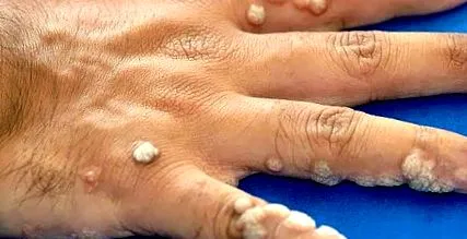 papilloma