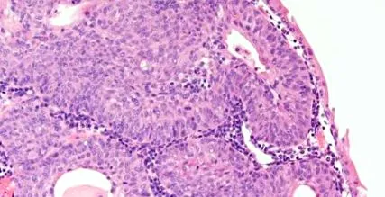 pleomorf adenoma pleomorf adenoma
