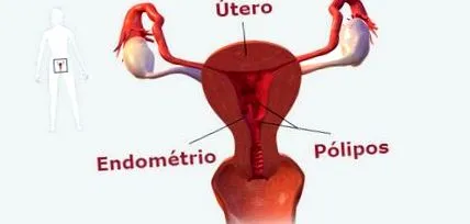 polyp