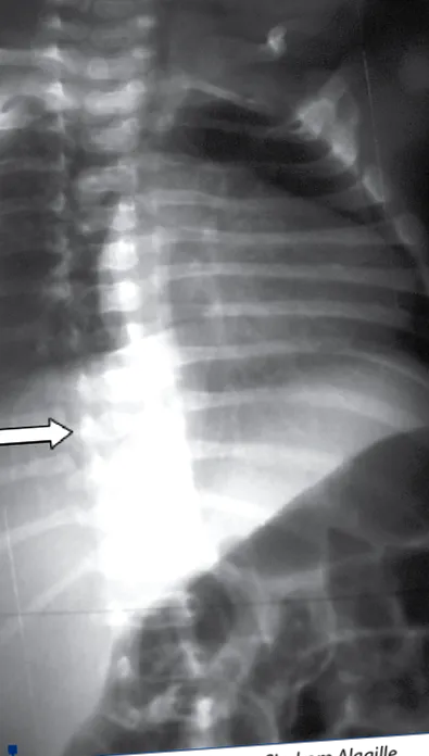 intrahepatikus